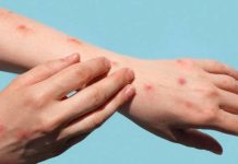 Kızamık vakalarındaki artışın nedeni açıklandı!